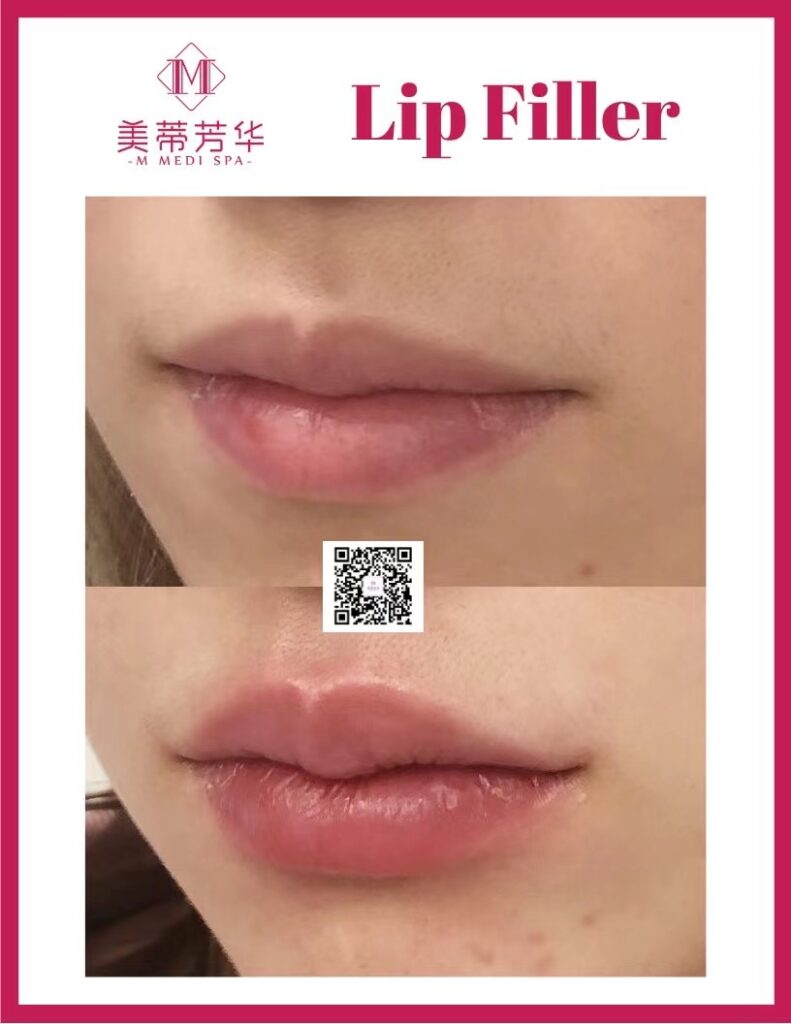 玻尿酸填充 2