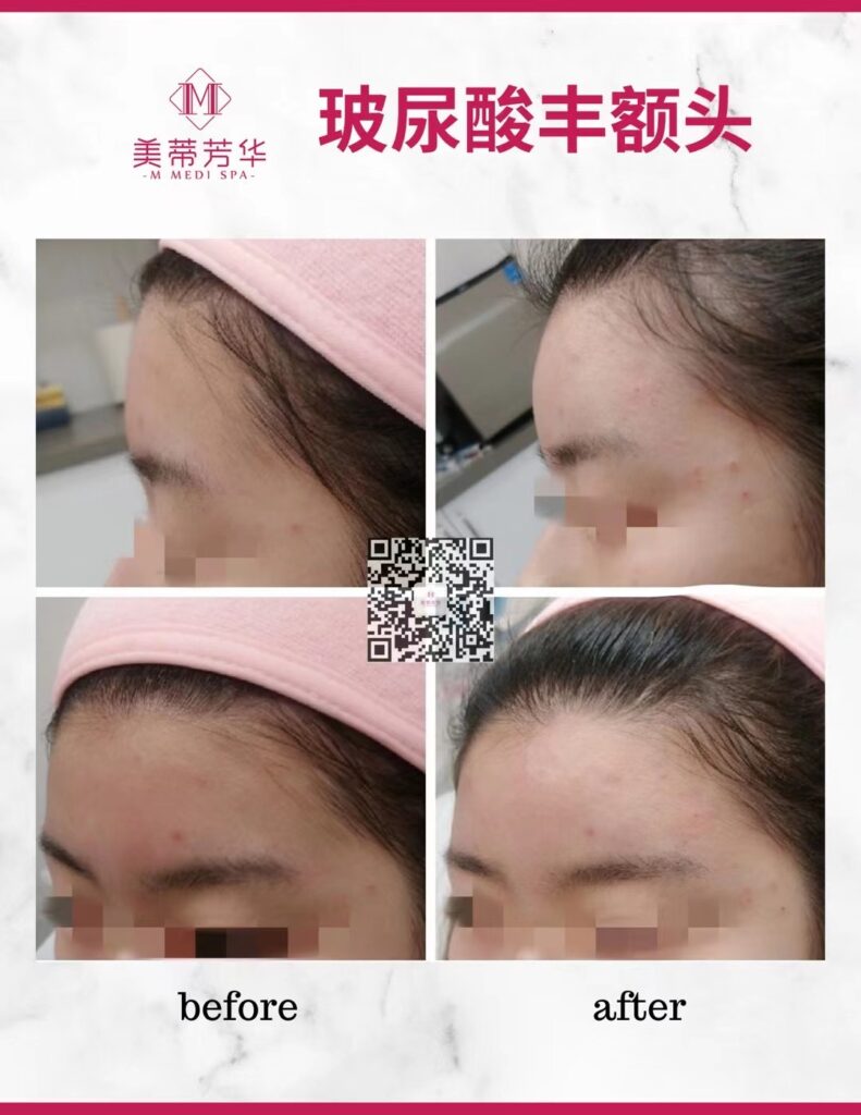 玻尿酸填充 4