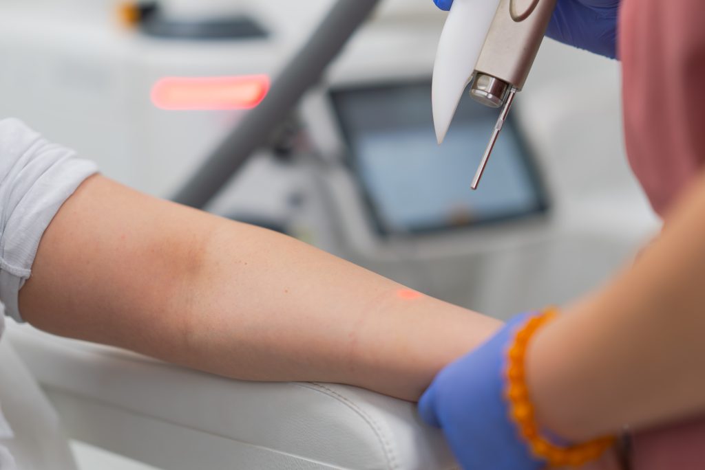 激光脱毛 多伦多