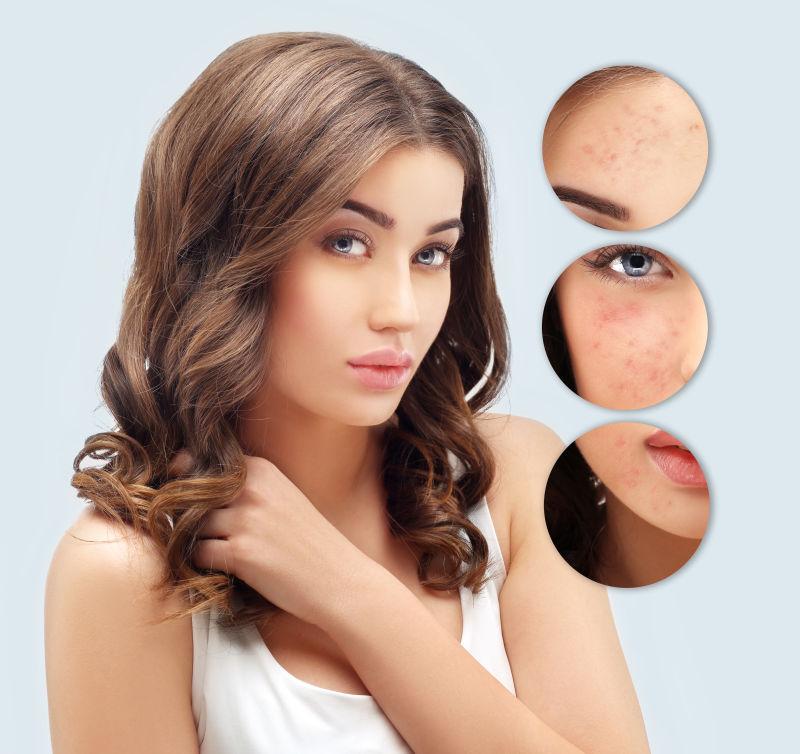 2025 多伦多黄金微针全攻略：如何改善痘坑 / 毛孔 / 初老？美蒂芳华解析