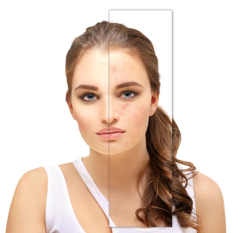 敏感肌/痘肌逆袭指南 | 多伦多美蒂芳华医美定制修复方案