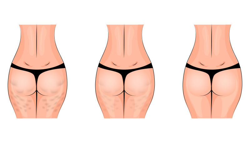 What Is the Butterfly Buttock Lift? (2025 Guide for Toronto Patients)