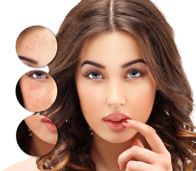 Pico Laser 2025: Erase Acne Scars Before Toronto’s Festival Season | M Medi Spa