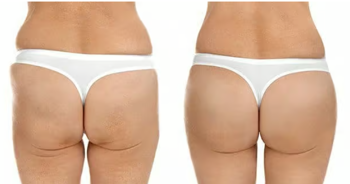 Sculptra BBL Toronto