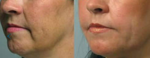 ultherapy before and after toronto