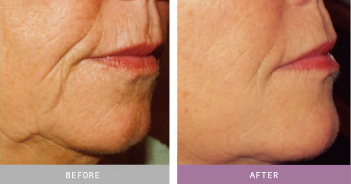 sculptra face toronto