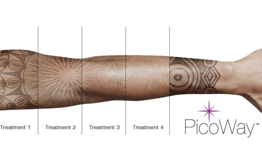 picoway laser near me