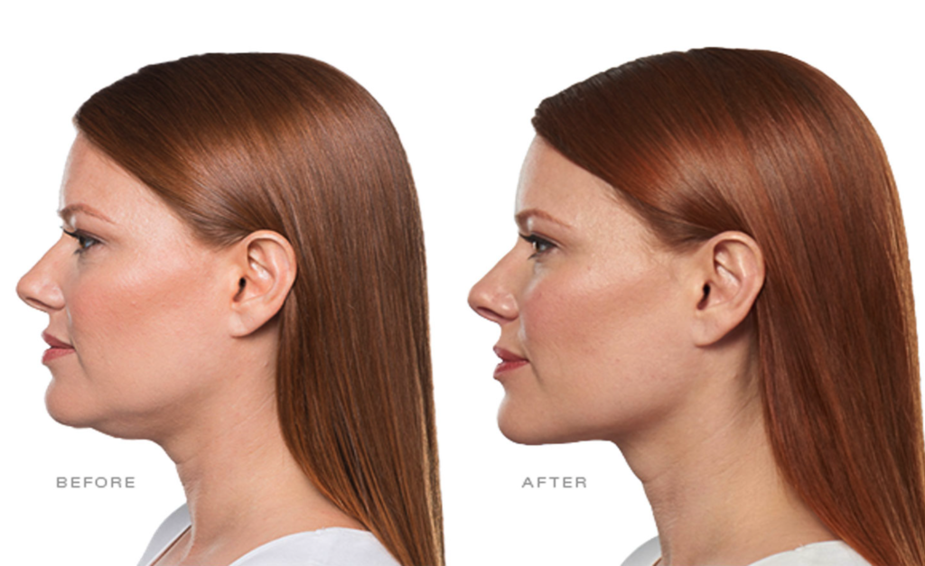 how many weeks.between belkyra