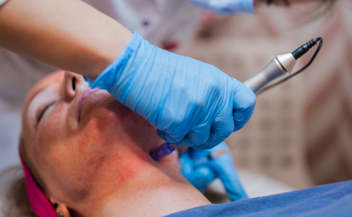 microneedling markham