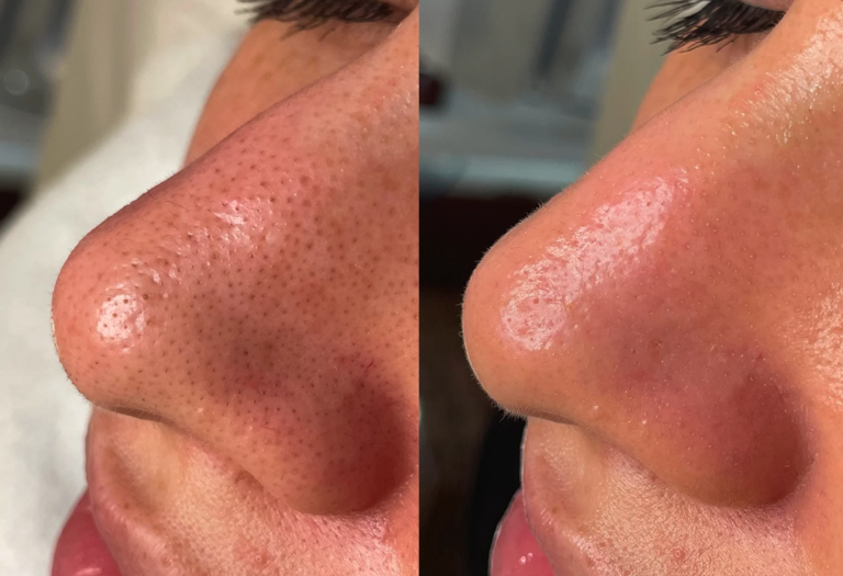 are hydrafacials worth it