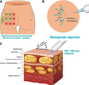 Butt Injections Toronto